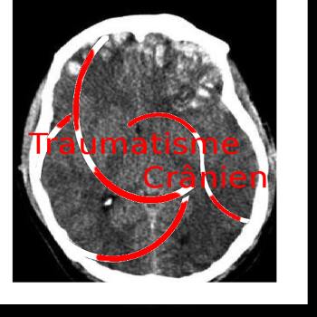 Traumatismes crniens - Comprendre l'Urgence et la Rducation